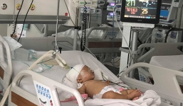 Bé gái bị khỉ con nhà hàng xóm cắn lún sọ