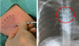 Que tránh thai 'đi lạc' lên tim, phổi: Chuyên gia sản khoa Việt lý giải nguyên nhân