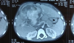 Bé gái 2 tuổi người Việt mang khối u ác tính ở gan cực hiếm gặp trên thế giới