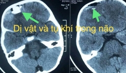 Nghịch súng tự chế, bé trai bị chấn thương sọ não