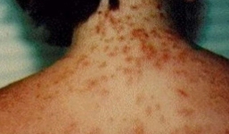 Nhiều bãi biển tại Mỹ đang gặp họa vì bị loại quái vật tí hon 'ăn thịt người' này xâm chiếm