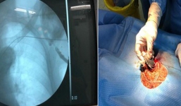 Cụ ông 101 tuổi đi qua cửa tử với chiếc máy tạo nhịp trong tim