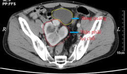 Ca bệnh hiếm gặp ở Tuyên Quanh: Thận nằm lạc chỗ 61 năm mới được phát hiện