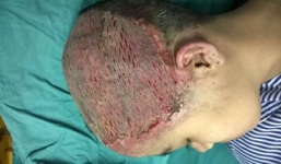 Thiếu nữ 17 tuổi lột hết da đầu sau khi uốn tóc mừng sinh nhật