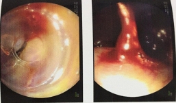 Người đàn ông nôn ra máu tươi, suýt mất mạng vì thứ đồ uống nhiều người thích