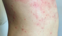 Thông tin mới nhất vụ dị ứng bất thường sau khi tắm biển Đà Nẵng