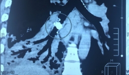 Mất nửa lá phổi vì hóc xương cá 5 năm trước