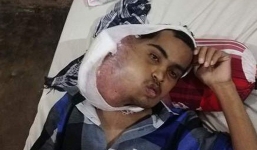 Thanh niên 21 tuổi bị ung thư miệng sau khi nhổ răng, hàm sưng to như quả bóng