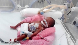 TP.HCM: Bé gái sơ sinh nặng chỉ 600 gram, tổn thương tim nguy kịch được cứu sống 'thần kỳ'