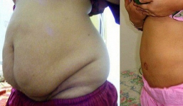 Câu hỏi lớn nhất khi hút mỡ bụng: Hút xong có bị béo lại hay không? Đáp án cực kỳ bất ngờ đấy!