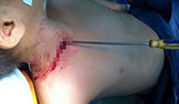 Một chiến sĩ công an bị đâm trọng thương khi đang làm nhiệm vụ