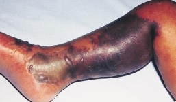 Loại khuẩn gây chết người trong 1 ngày này có thể bùng nổ khi cơn ác mộng kháng kháng sinh ập đến