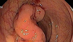 7 anh em ruột ở Hải Dương cùng mắc 1 loại ung thư: Bác sĩ chỉ rõ 6 dấu hiệu bệnh nguy hiểm