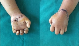 Nghịch máy cắt cỏ, bé gái 31 tháng tuổi bị đứt lìa bàn tay trái