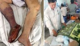 Uống thuốc tim mạch không đều, người đàn ông 46 tuổi phải cắt bỏ chân