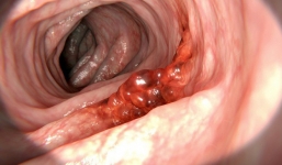 Đây là 3 'thủ phạm' gây tăng nguy cơ ung thư nhưng nhiều người rất thích ăn