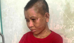 Lời kể của cô gái đi làm thuê bị chủ dùng bàn là ủi mặt, kìm bẻ răng và cắt tai