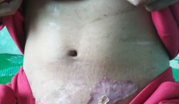 Vụ cô gái nghi bị tra tấn dã man: Sau nửa tháng đánh đập, nạn nhân phát hiện bị sẩy thai