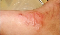 Nam bệnh nhân ở Củ Chi bị nhiễm trùng nặng do giun lươn bò lúc nhúc dưới da