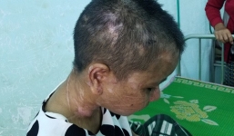 Cô gái bị tra tấn dã man như thời trung cổ được bác sĩ Chiêm Quốc Thái tài trợ phẫu thuật miễn phí