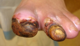 Con số giật mình: 7 giây có 1 người chết vì bệnh này, số người mắc ở Việt Nam tăng nhanh