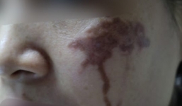 Hai má của người phụ nữ ở Hà Nội bị loang lổ vết thâm đen sau khi trị nám bằng axit tại spa