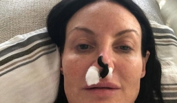 Hy hữu: Nhờ đỉa hút máu, cứu được chiếc mũi phẫu thuật thẩm mỹ hỏng