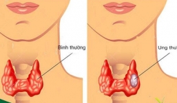 6 dấu hiệu cảnh báo ung thư tuyến giáp sớm nhất: Cơ hội sống gần 100\% vì điều trị kịp thời