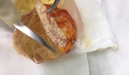 Tai nạn nâng ngực: Sau 3 năm đầu mềm mại và đẹp là 17 năm đau đớn, túi ngực vỡ tan