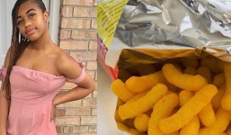 Ăn cay quá nhiều, cô gái 17 tuổi ở Mỹ phải cắt bỏ túi mật của mình