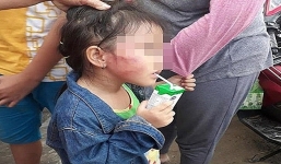 Vụ bạo hành trẻ ở Bình Chánh: Bé gái 5 tuổi có bị gãy xương hàm?