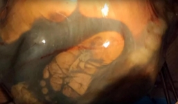 Hiếm gặp: Mang thai suốt 41 tuần không đi siêu âm, đến lúc đẻ bác sĩ phát hiện sự thật không thể tin nổi