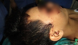 Nam thanh niên bị lưỡi cưa 12cm găm sâu vào mặt khi cưa nhôm