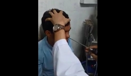 Đỉa dài 3cm sống kí sinh 3 tháng trong hốc mũi của người đàn ông