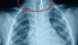 Bé trai 26 tháng tuổi ở Nghệ An bị thủng thực quản do nuốt móc sắt