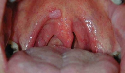 BS tiết lộ 4 dấu hiệu 'kinh điển' của ung thư vòm họng: Dù khoẻ mạnh biết vẫn không thừa