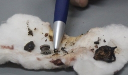 Quảng Nam: Bác sĩ gắp được cả lưỡi câu, bật lửa từ trong phổi bệnh nhân