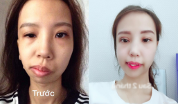 Bị bạn bè trêu chọc vì teo nửa bên mặt, cô gái Hà Nội lột xác sau phẫu thuật thẩm mỹ