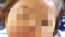 Tiêm ngừa bị nhiễm trùng, bé gái 32 tháng tuổi phải phẫu thuật đùi trái 3 lần