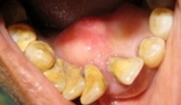 Nữ sinh bị khối u 'ăn xương hàm': Chuyên gia cảnh báo dạng u này xuất hiện nhiều ở VN