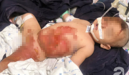 Chạy chơi vấp phải dây điện ấm đun siêu tốc, bé gái 20 tháng tuổi bị bỏng nước sôi kinh hoàng