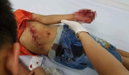 Mẹ hoảng hốt phát hiện con trai 8 tuổi bê bết máu sau khi đồ chơi chạy pin phát nổ