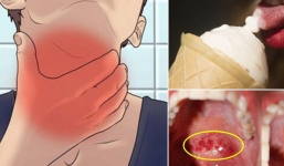 Sự thật không ai ngờ tới về quan niệm: 'Đau họng không được uống nước lạnh và ăn kem'