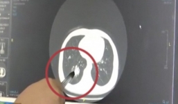 Nuốt phải nắp bút, 40 năm sau mới được bác sỹ lấy ra khỏi cơ thể