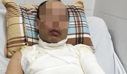 Hà Nội: Con gái ngồi trong xe ô tô sợ hãi chứng kiến cảnh bố bị tạt axit khắp cơ thể