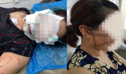 Người phụ nữ tố bị chồng ghen tuông cắt 3 gân chân, rạch mặt