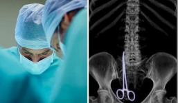 Quên kéo 15cm trong bụng bệnh nhân 6 tháng, bác sĩ quả quyết bị ung thư