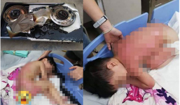 Cùng mẹ chơi dưới bếp, bé trai 2 tuổi bị bỏng nặng khi mặt bếp bất ngờ phát nổ, lời cảnh báo đáng sợ dành cho các phụ huynh