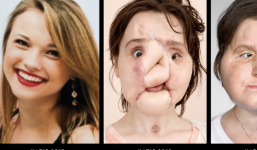 Ca phẫu thuật lịch sử dài 31 giờ trả lại gương mặt xinh đẹp cho cô gái 21 tuổi