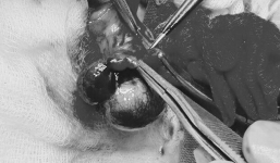 Con kêu đau bụng dưới, bố mẹ tưởng bình thường, sáng hôm sau đến viện cấp cứu thì đã muộn